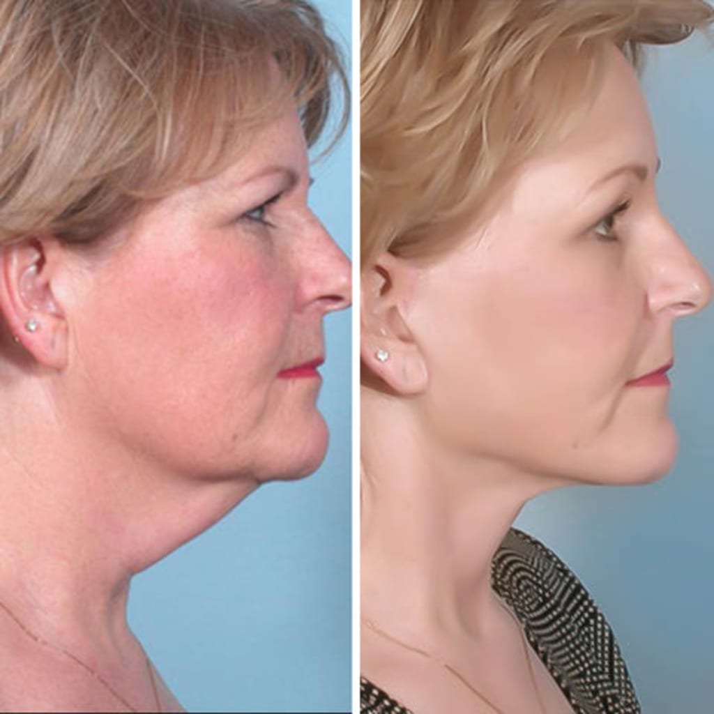 Facial Massage Device