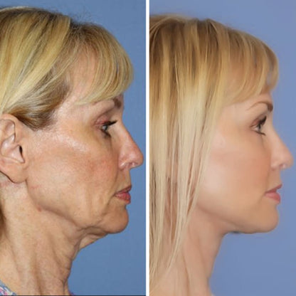 Facial Massage Device